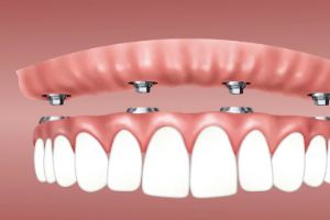 용인시-기흥구-임플란트-치과-가격-비용-싼-곳,저렴한-곳,잘하는-곳,유명한-곳-BEST20-추천18