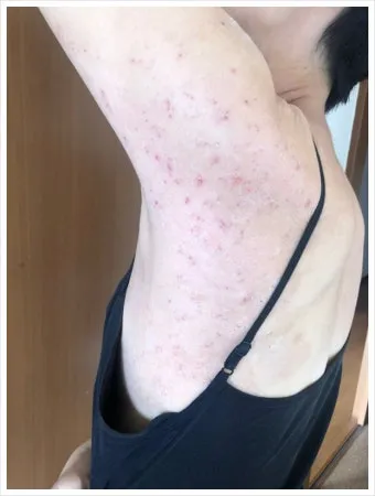 에로콤크림 코르티코이드 반응성 피부질환에서의 염증가려움 완화 전략에 대한 사용수칙_10