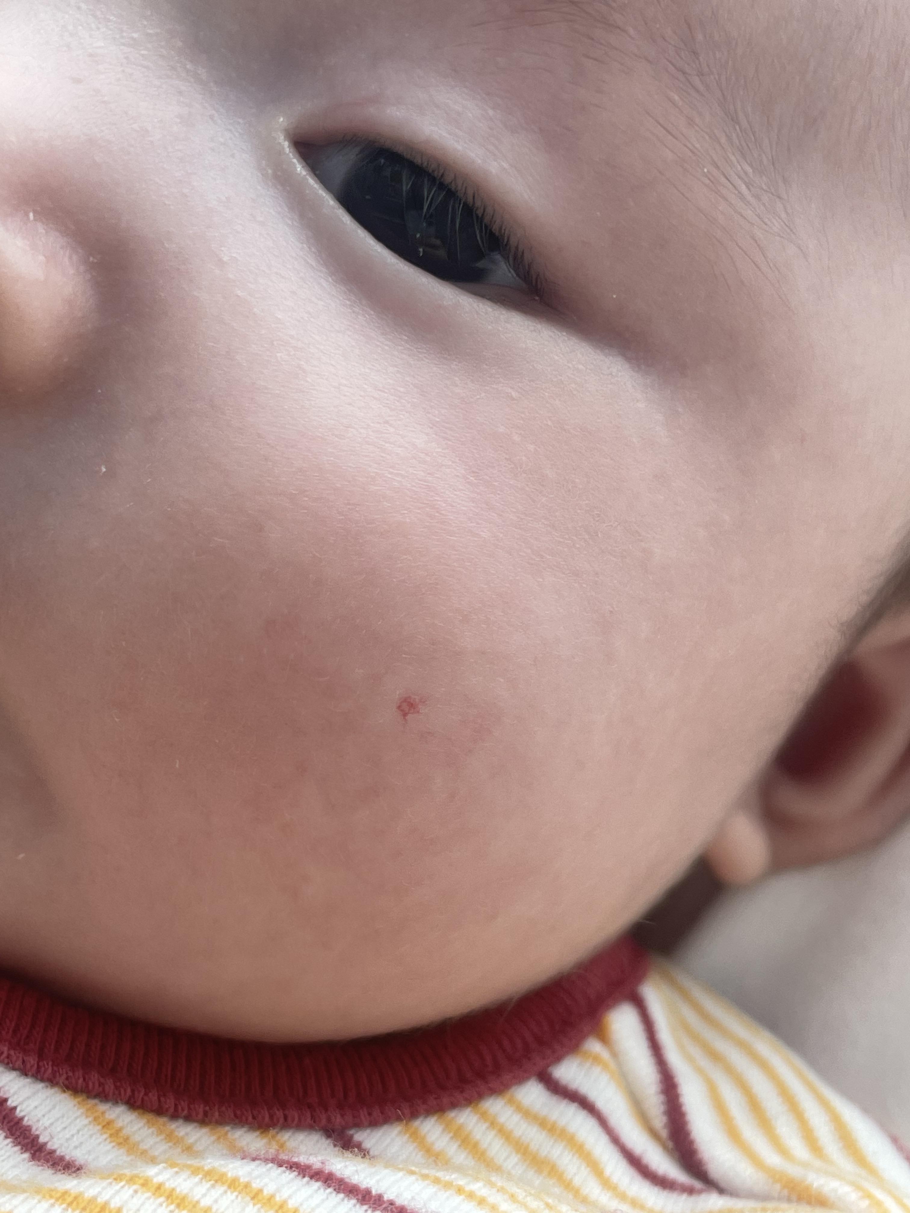 혈관종 에스앤유 피부과