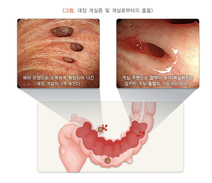 대장 게실증 출혈