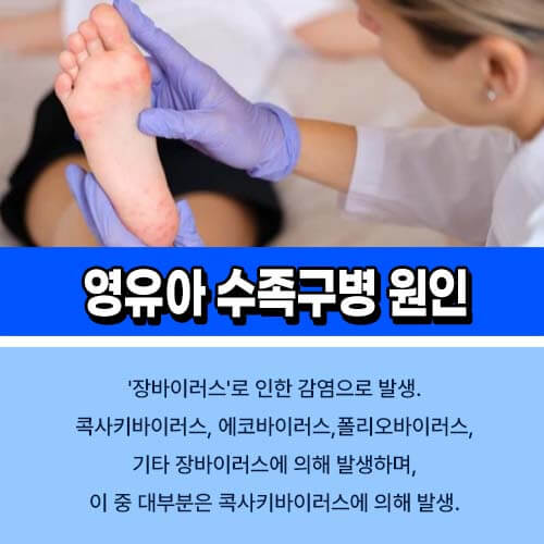 수족구병 원인