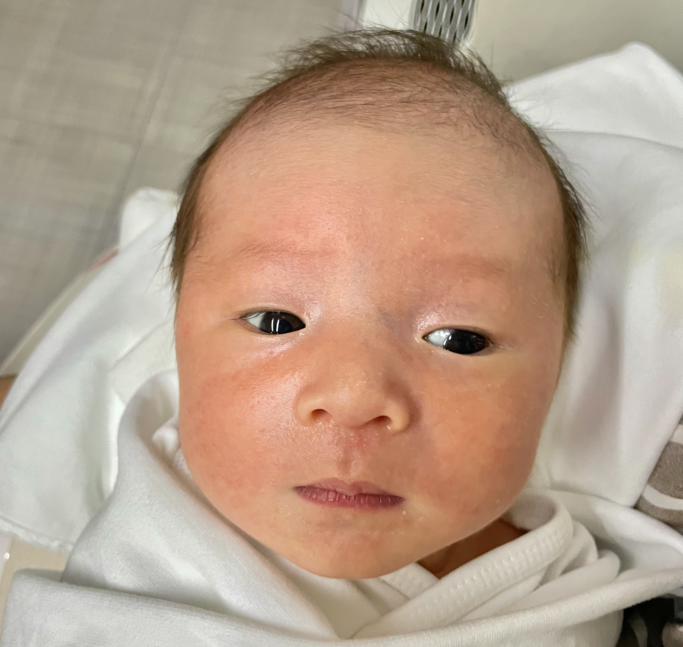 혈관종 에스앤유 피부과