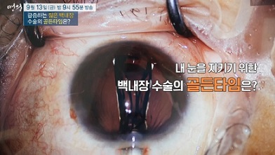 백내장골든타임