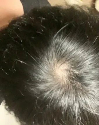 정수리가 아픈 이유와 완화하는 방법_11