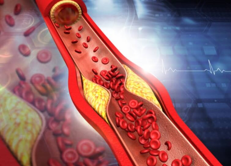 콜레스테롤정상수치