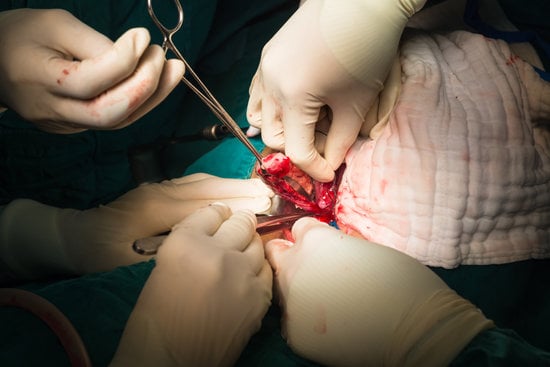 정맥 결찰 및 제거술(Ligation and Stripping)에 대한 이해