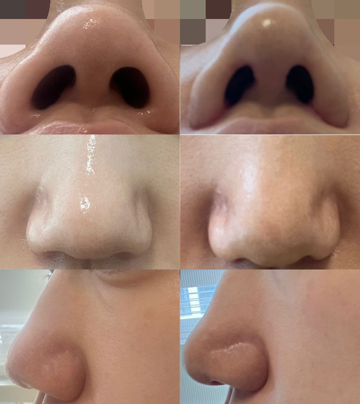 콧볼축소수술후기