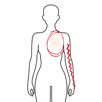 목디스크_방사통_위치
