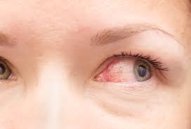 눈 실핏줄이 터지는 이유