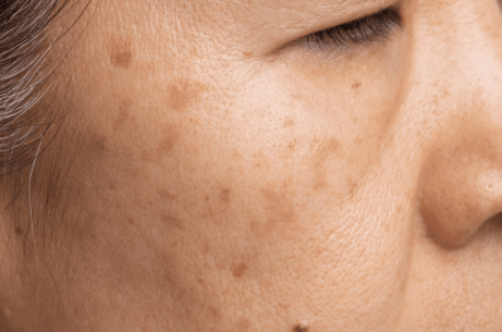 갱년기 이후 발생하는 기미, 검버섯, 도미나 크림으로 발라보니 2달 소요