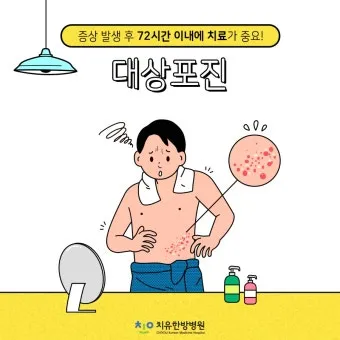 대상포진 치료방법에 대한 총정리 건강 질병관리_19