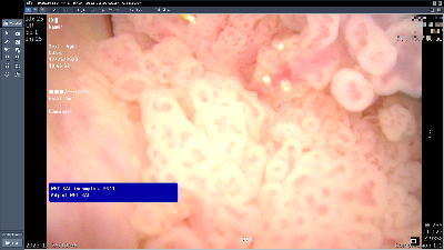 방광암 내시경 사진