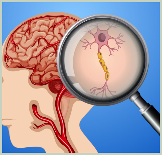 뇌출혈 초기증상 원인