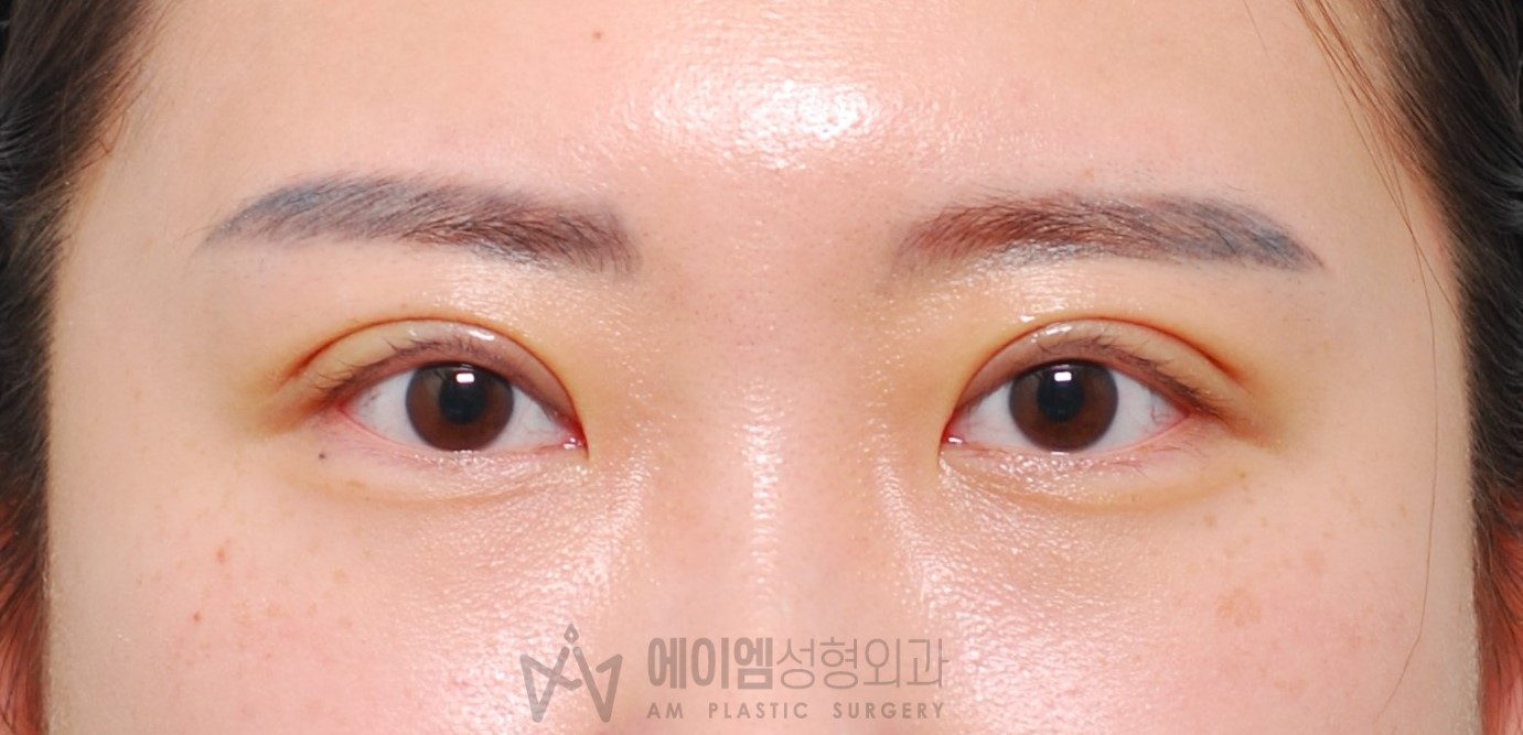 소세지눈 두줄따기 10일