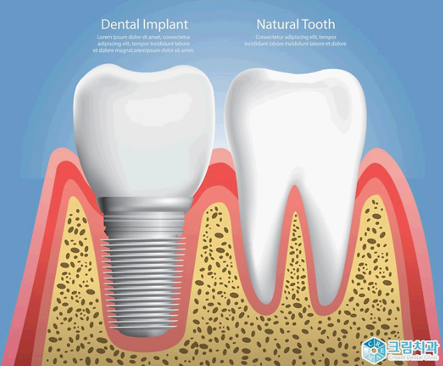 임플란트 보철재 비교 총정리 (Gold PFM Zirconia )
