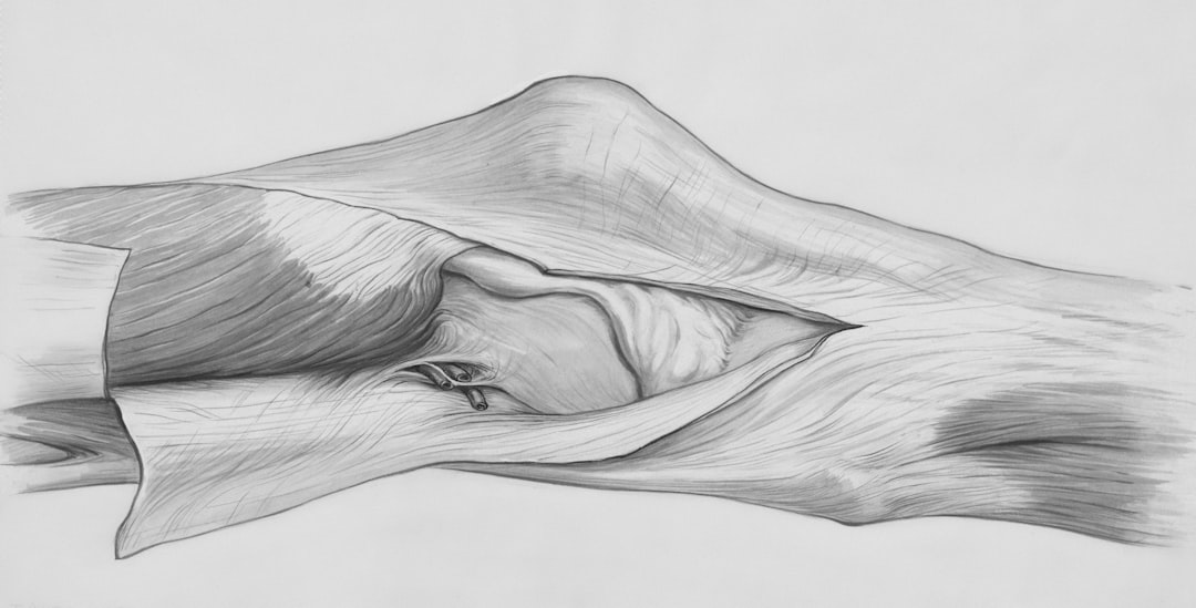 Arrhythmia.