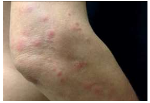 빈대 물린 흔적