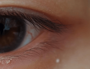 눈밑에 하얀 좁쌀