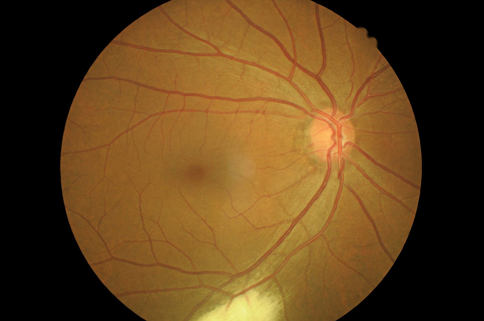공기 주입술 (Pneumatic Retinopexy): 망막박리 치료