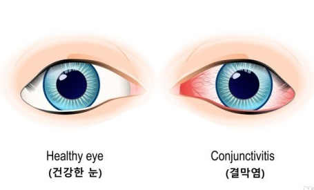 브로낙점안액 결막염에 사용