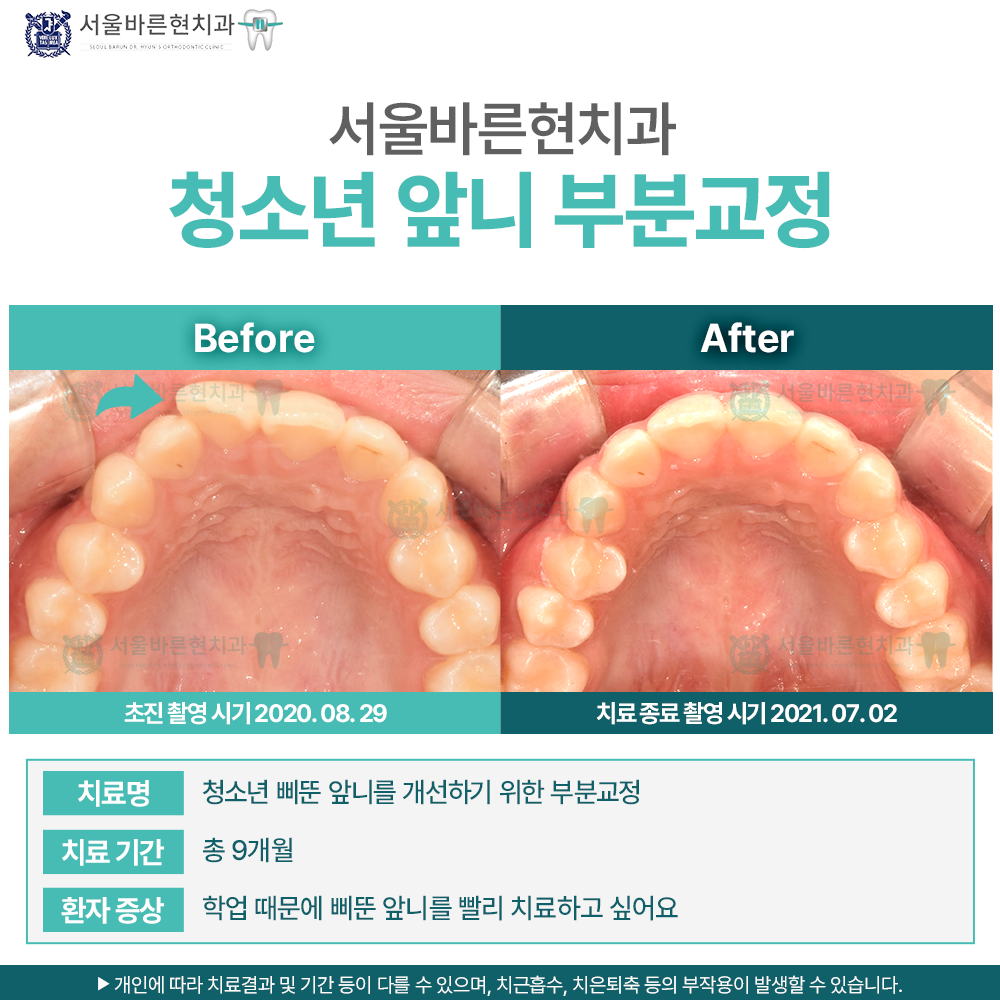 부산 교정 치과
