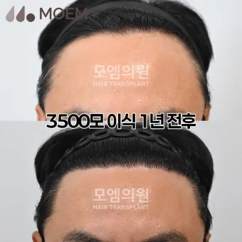 머리카락 이식 3000모 3000모낭 비용과 시술 과정_16