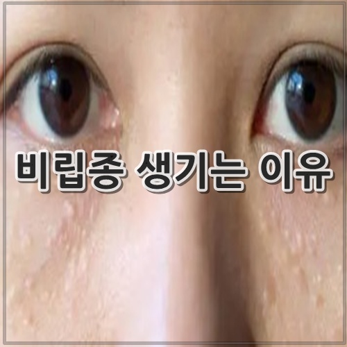 비립종 생기는 이유