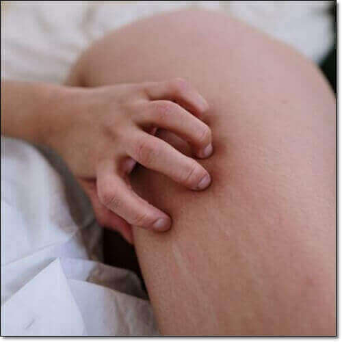 자가면역질환 두드러기 증상, 원인 및 예방과 치료