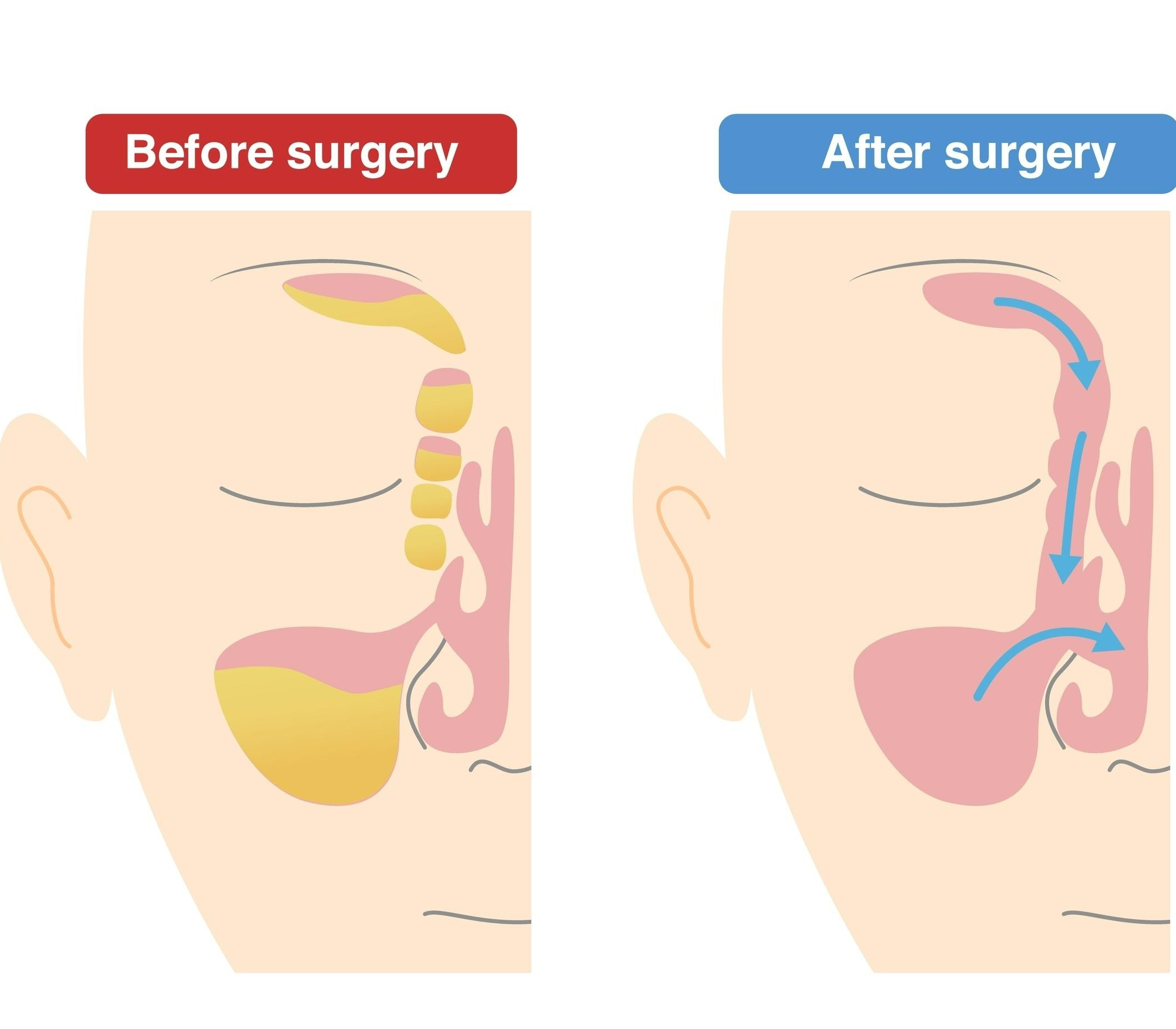 부비동 수술위치