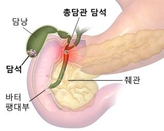담석증 증상