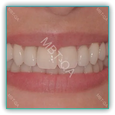 앞니 임플란트 형태2