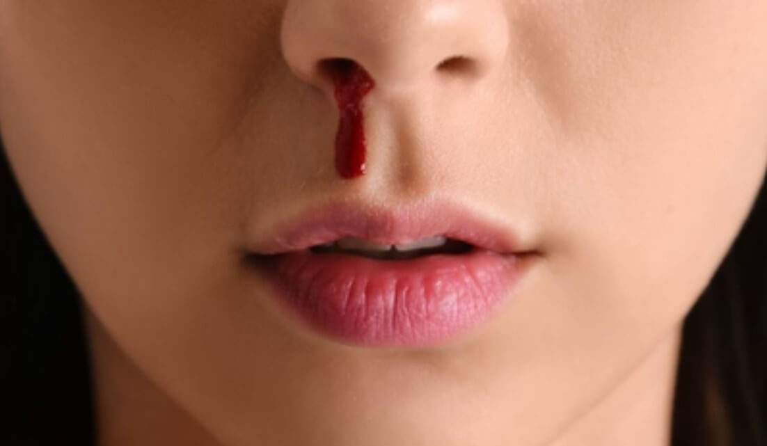 한쪽 코에 코피 흘리는 여성