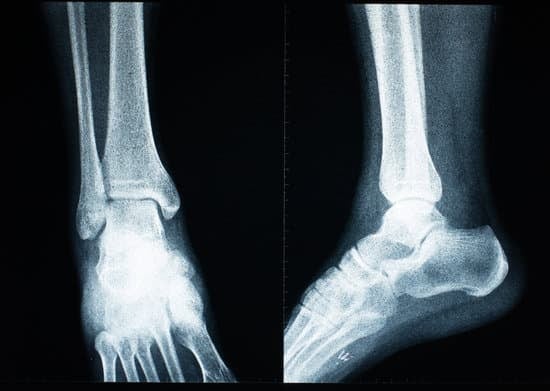 족관절 인공관절 치환술 (Total Ankle Replacement)