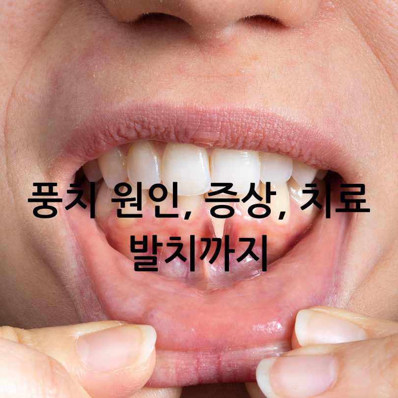 풍치 원인, 증상, 치료법부터 발치