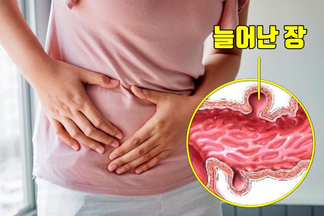 복통 원인 장에 독소가 쌓이면, 장독소배출방법 장독소자가진단, 장게실염 대장암, 건강 팁줌 매일꿀정보