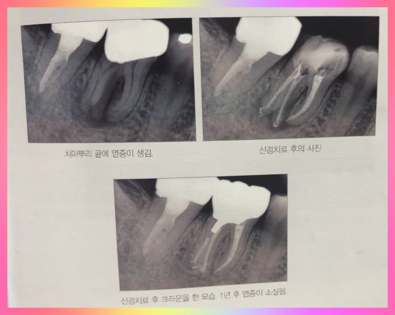 신경 치료 모습