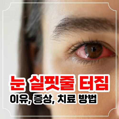 눈 실핏줄 터짐 이유와 증상 및 치료 방법