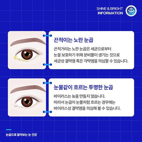 난시 라식