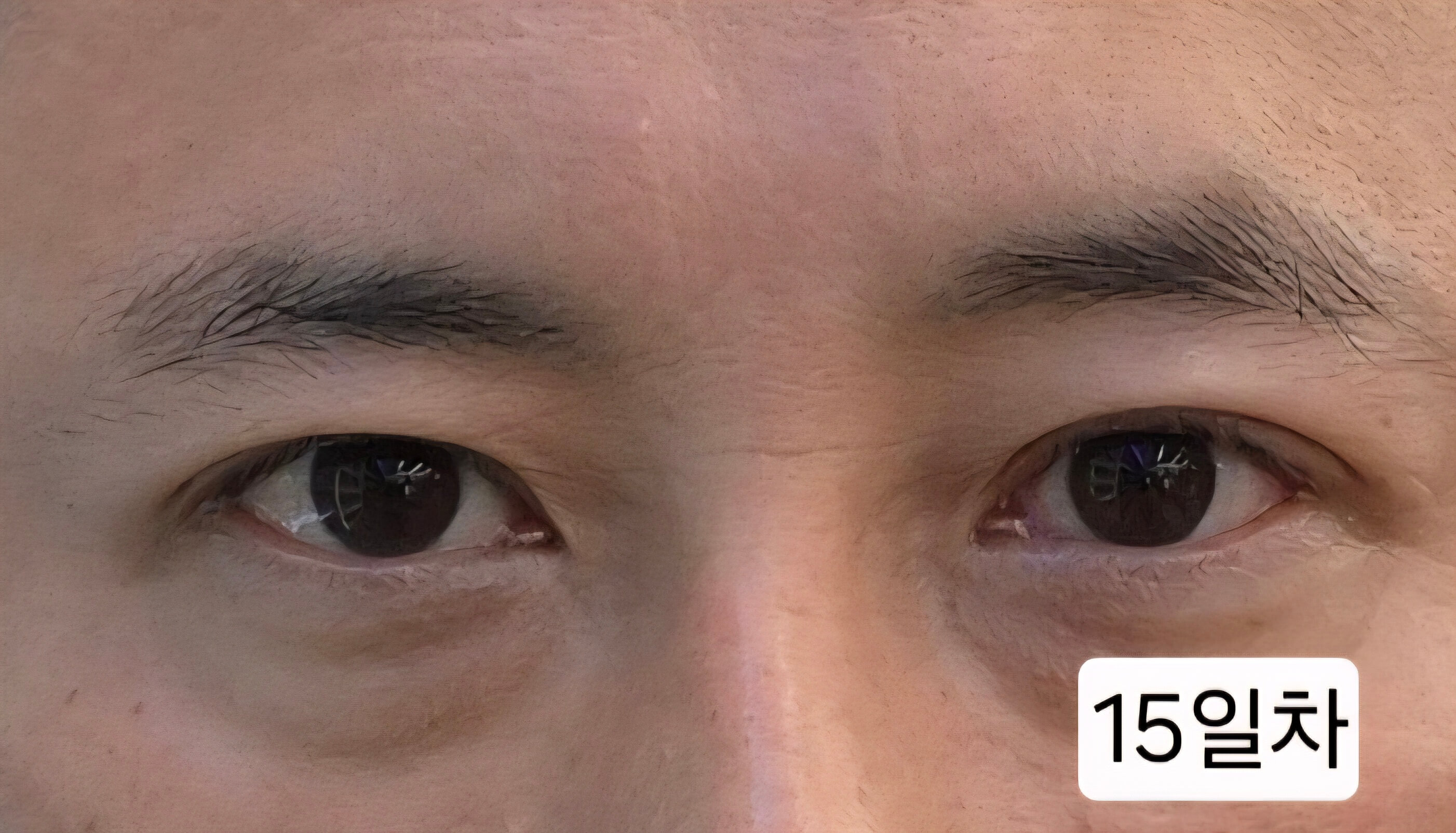 유행성각결막염 치료과정 증상 시력저하 회복과정 발병2주 3주 기록