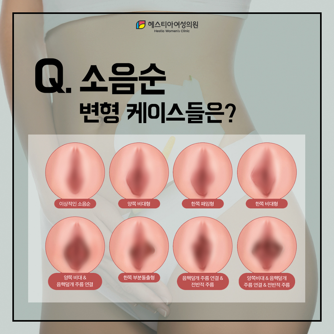 다양한 소음순변형