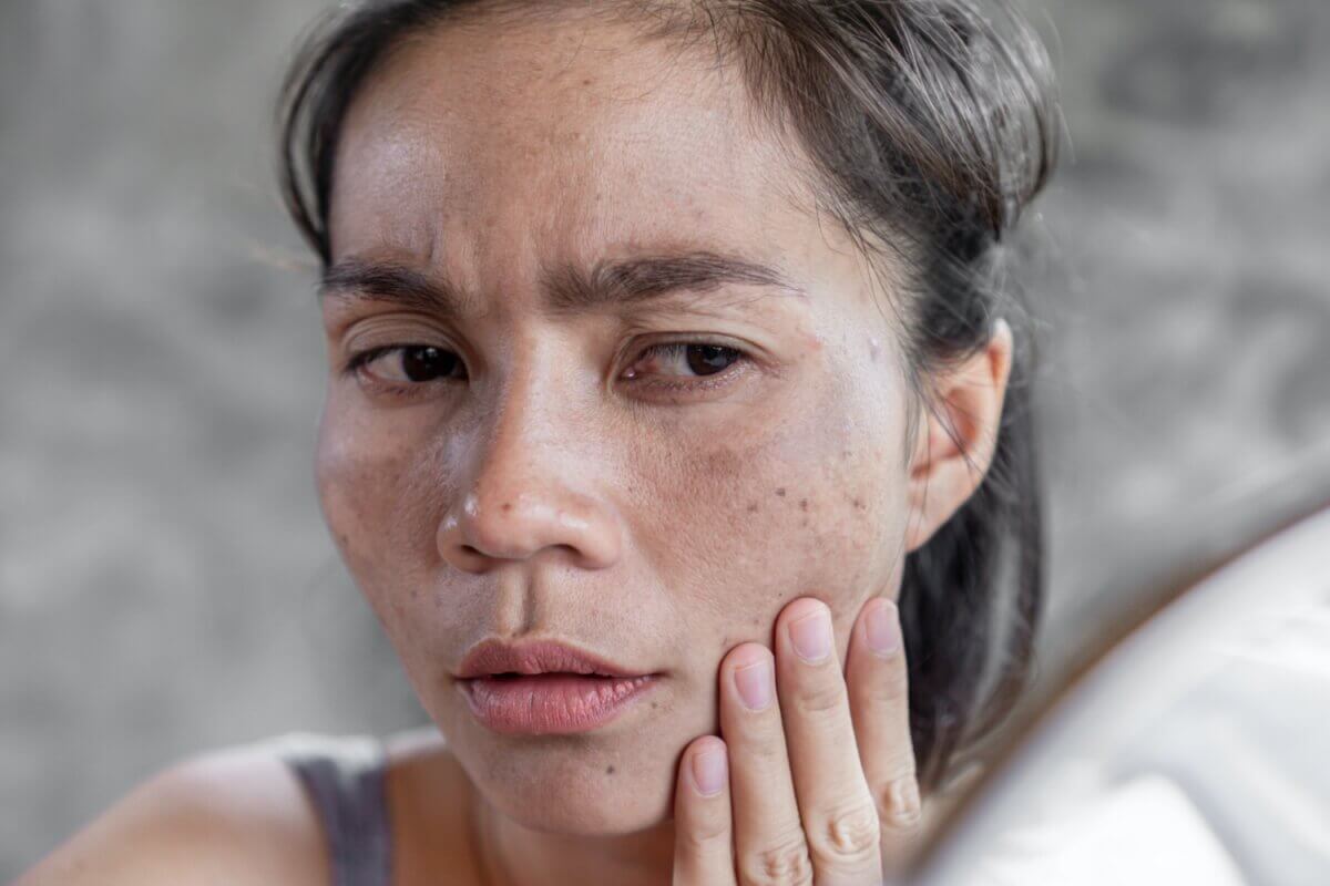 오타모반이-발생한-여성