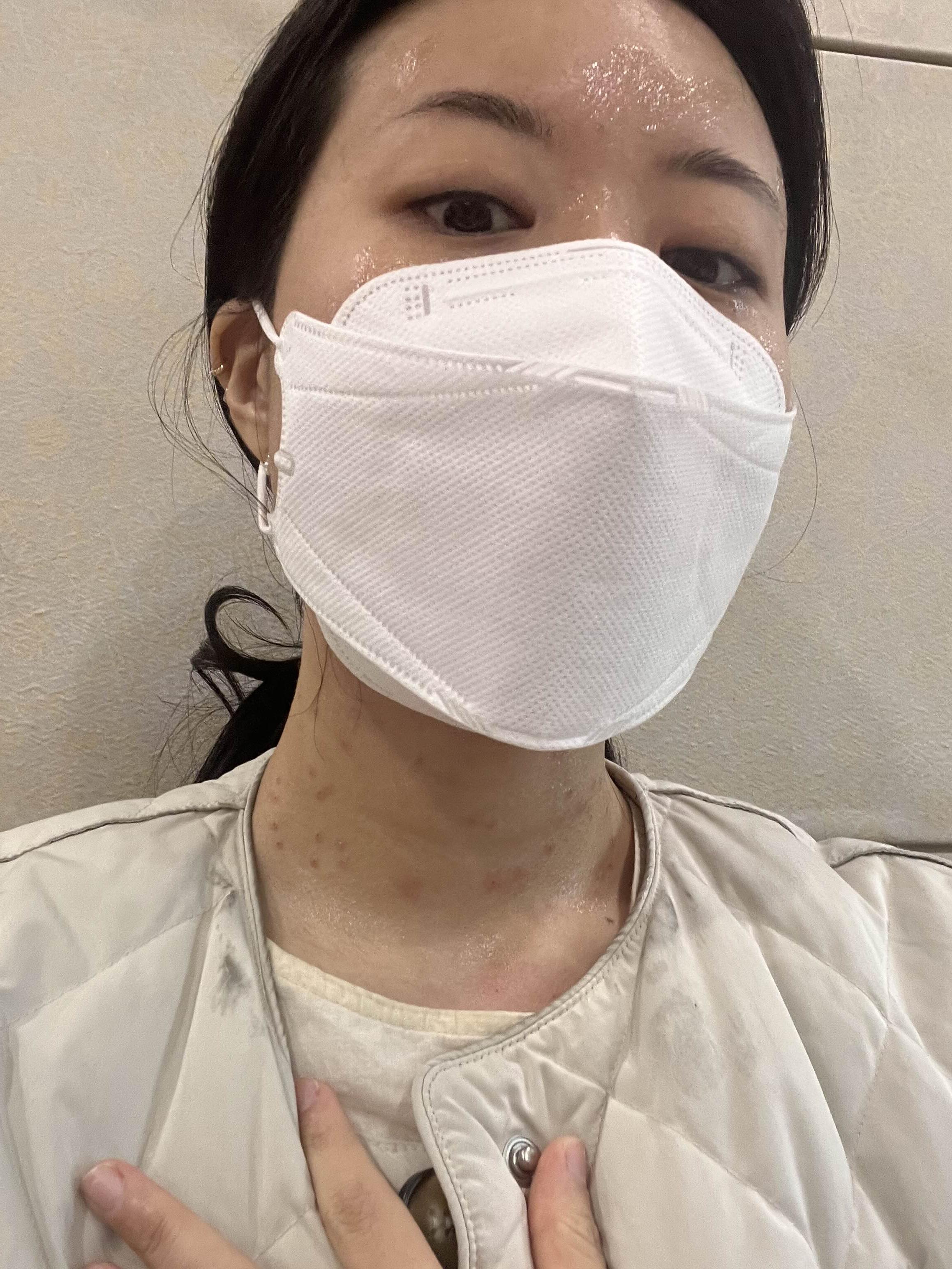 편평사마귀 치료 후 후시딘 평평사마귀 목