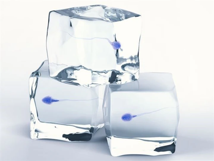 정자-냉동-보관