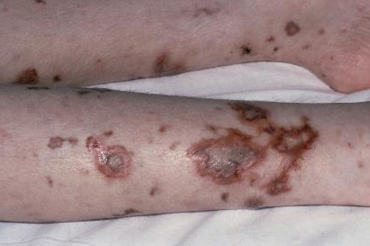 수막구균 감염증에 감염된 다리