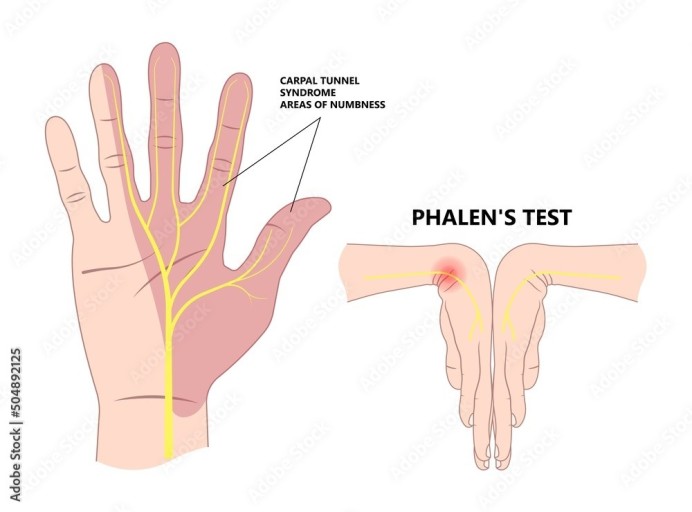 손목터널 증후군