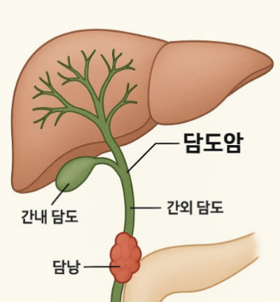 담도암 이란