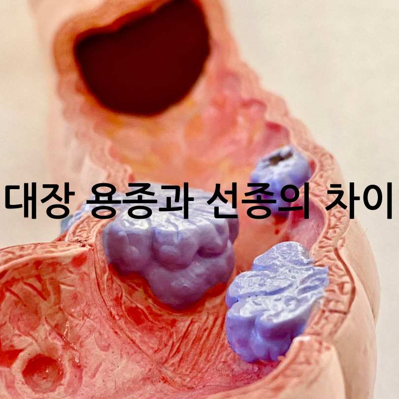 대장 용종과 선종의 차이점부터 예방법