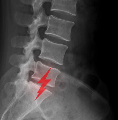 요통 원인과 증상