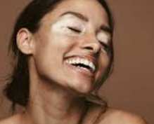 백반증 초기증상 22