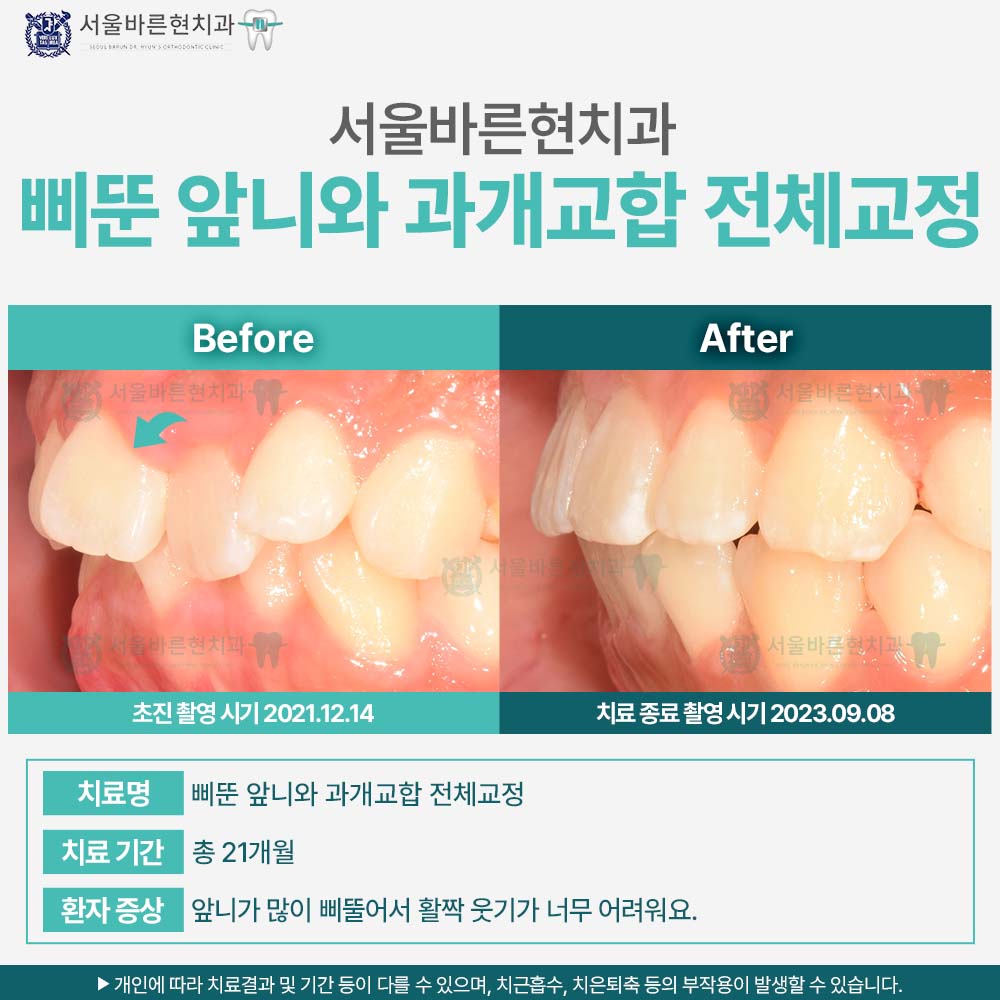 해운대치아교정